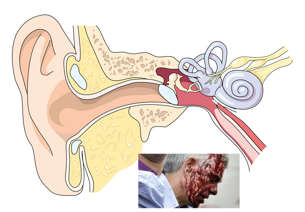 garzon ear2